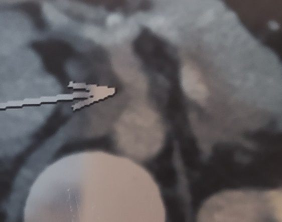 Figure 1: A false channel of the celiac trunk (arrow) without associated aneurysmal dilation.