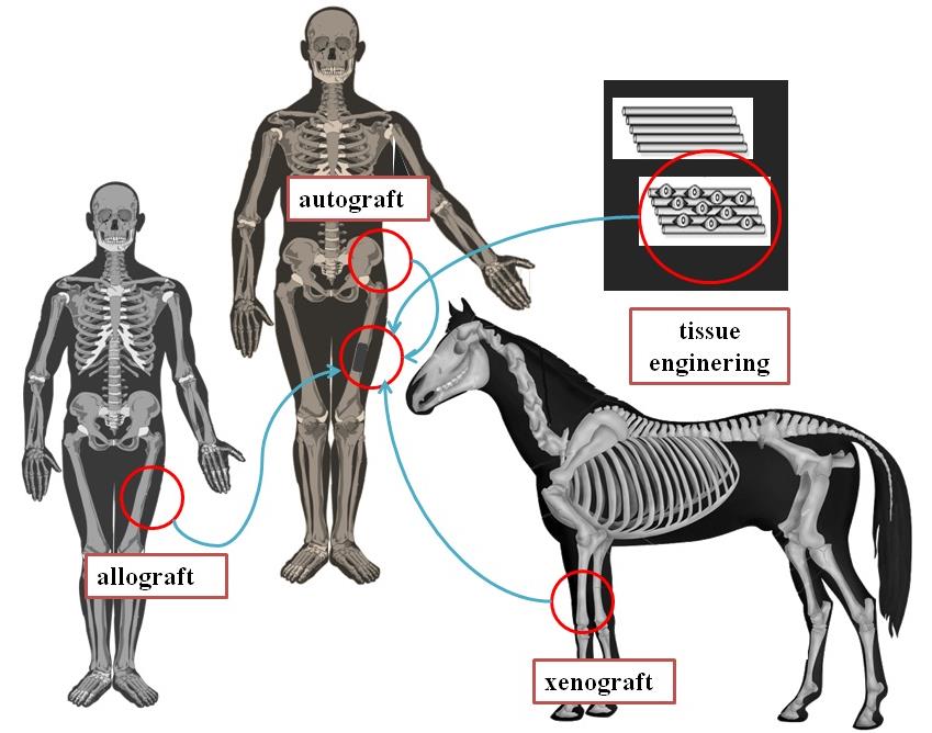 Figure 1: All type of bone grafting, autograft, allograft, xenograft and tissue engineering.