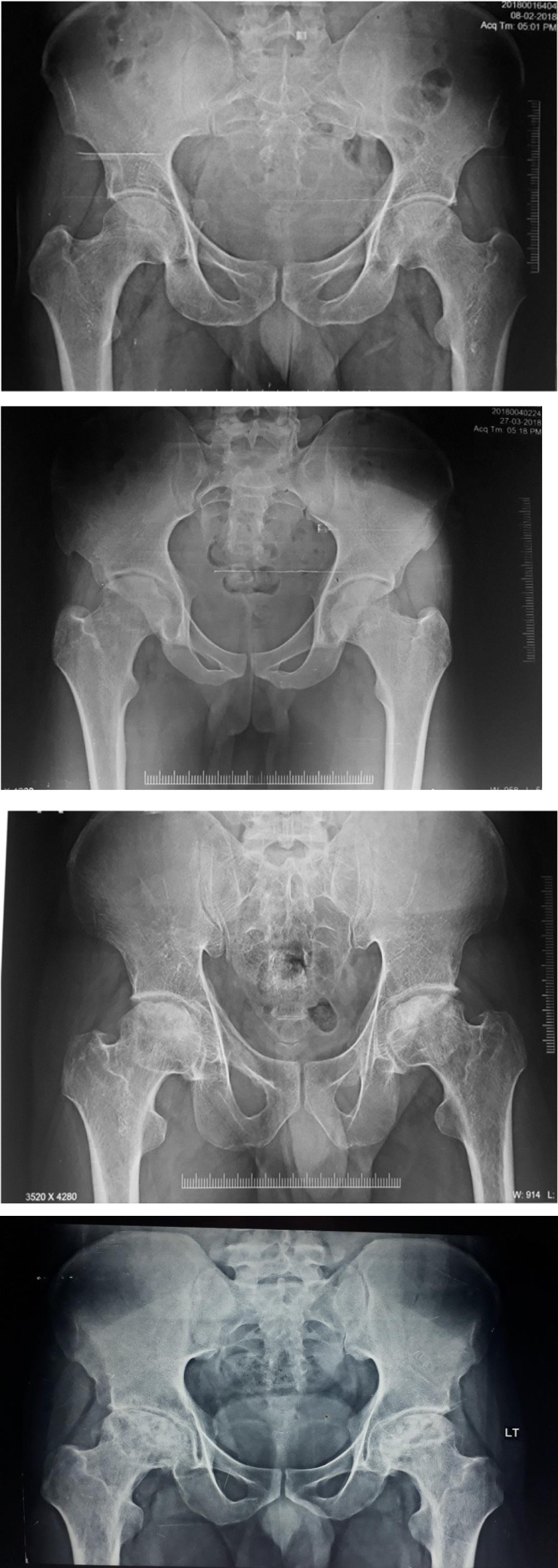 Figure 1: Various stages of osteonecrosis of femoral head.