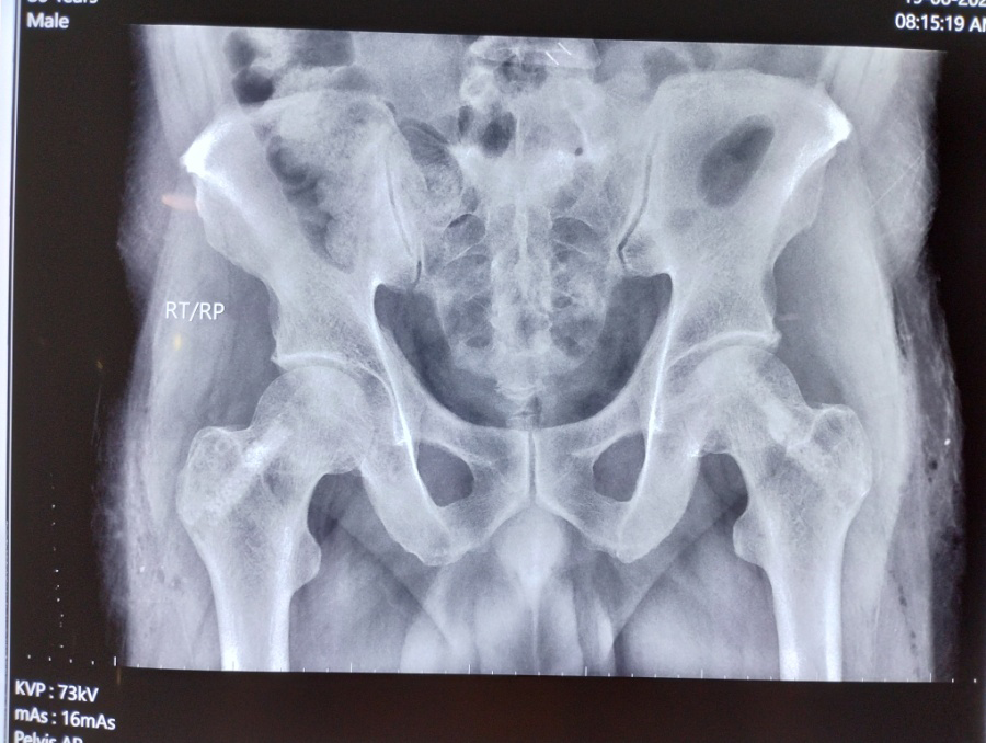 Figure 2: X-ray Pelvis with both hips showing bilateral core decompression with MSC insertion (along with artificial bone graft).