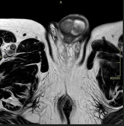 Figure 1: An MRI pelvis axial view showing the penile lesion while it is more prominent on the left side.