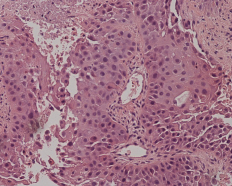 Figure 2: Histopathology slide of penile biopsy showing metastatic transitional cell carcinoma of the corpora.