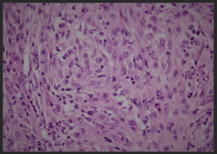 Figure 2: Decidualized cells and a figure of mitosis 20x.