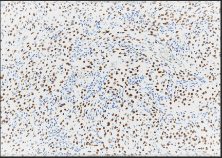 Figure 3: Immunoreactivity with WT1 in tumor cells 20x.