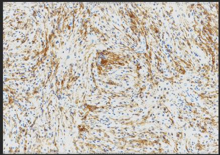 Figure 4: Image indicating positivity for CD10 in tumor cells 20x.