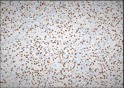 Figure 5: There is strongly positive progesterone staining 20×.