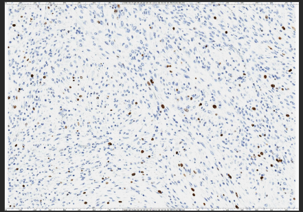 Figure 6: High Ki-67 proliferation index 20x.