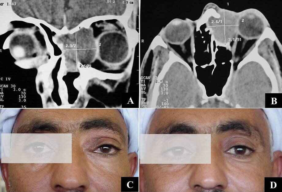 Figure 1: (A) CT scan with a coronal soft tissue cut showing a left fronto-ethmoid mucocele displacing the inter-frontal septum to the right, eroding the sinus floor, and displacing the globe; (B) CT scan with axial soft tissue cut showing the mucocele involving the anterior ethmoid air cells with eroded lamina papyracea and displaced globe; (C) Pre-operative photo showing swelling on the inner aspect of the left globe with down and out proptosis; (D) Postoperative photo 4 days following ESS.