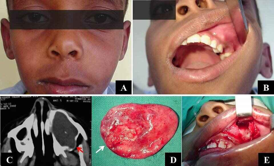 Figure 10: A nine-year-old boy with a left-sided cheek swelling caused by a radicular cyst (A), with obliteration of the left buccoalveolar sulcus, expansion of the anterior maxillary wall, and a carious upper left 2nd premolar tooth seen through the open mouth (B); (C) CT scan with axial soft tissue cut showing distension of the left maxillary sinus by the cyst with thinning out and erosion of the posterolateral maxillary wall (red arrow); (D) A photo of the removed cyst by enucleation; note the site of tooth reaction in the cyst wall (white arrow); (E) Operative photo showing a distended anterolateral maxillary wall with a window created in it through a sub-labial approach, with the cyst removed, and the sinus cavity seen.