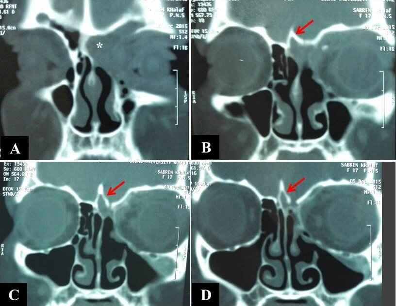 Figure 2: CT scan with coronal bone window cuts showing a left-sided FEM (white asterisk) eroding the floor of frontal sinus and lamina papyracea and displacing the globe (A), with distension of a pneumatized crista Galli by the mucocele (red arrows in B, C, D).