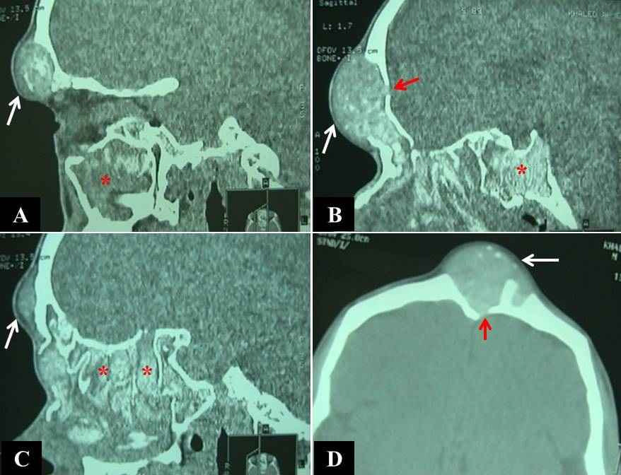 Figure 4: CT scan with sagittal (A, B, C) and axial (D) soft tissue cuts showing a well-defined frontal subcutaneous isodense soft tissue shadow (white arrows), with scattered high-density shadows of AM, with absent anterior walls of frontal sinuses, involving both frontal sinuses (D) with a localized erosion of the posterior wall of the right frontal sinus (red arrows in B, D), that proved to be a fungocele. Note the pan-sinus opacity with scattered high-density shadows of AM (red asterisks) in the maxillary sinus (A), sphenoid sinus (B), and ethmoid air cells (C)