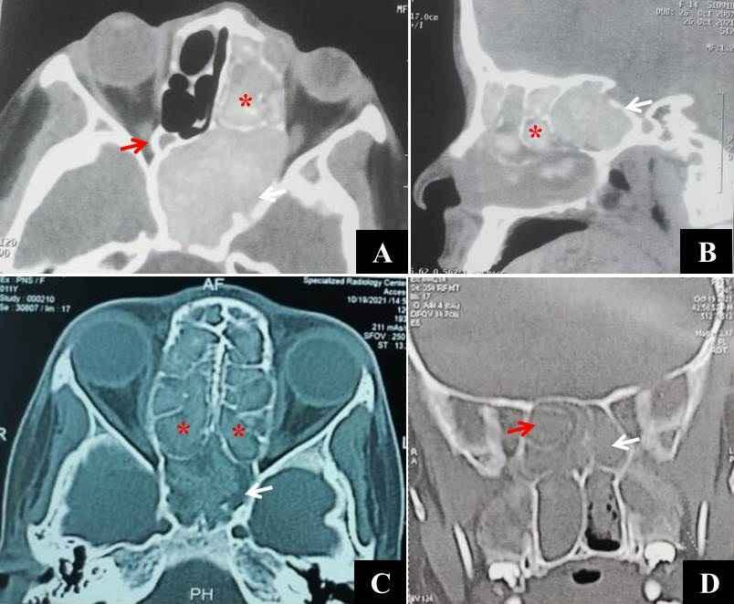 Figure 5: CT scan with axial (A) and sagittal (B) soft tissue cuts showing a left-sided sphenoid fungocele (white arrows), very small right sphenoid sinus (red arrow), and scattered high-density shadows of AM in ethmoid air cells (red asterisks); CT scan with axial (C) and coronal (D) bone window cuts showing a bilateral sphenoid fungocele with an absent inter-sphenoid septum and merged sinuses (white arrows), bilateral AFS involving ethmoid air cells (red asterisks) and left Onodi cell invading the right sphenoid sinus (red arrow in D)