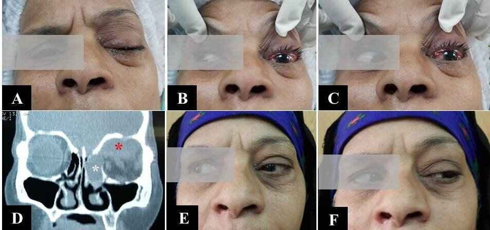 Figure 7: A 50-year-old female having left-sided total ophthalmoplegia due to cavernous sinus thrombophlebitis presented with ptosis and lid edema (A); a left-sided proptosis, orbital cellulitis, and ophthalmoplegia on looking to the right (B), and on looking to the left (C); (D) CT scan with coronal soft tissue cut showing a left-sided ethmoid pyocoele involving a concha bullosa and anterior ethmoid cells (white asterisk) with an erosion of the lamina papyracea, and a well-defined soft tissue shadow on the upper medial wall and roof of the orbit (red asterisk) due to sub-periosteal abscess; (E, F) Postoperative photos of the patient showing resolution of orbital cellulitis and regain of ocular motility on looking to the right and left.