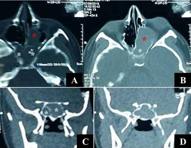 Figure 8: CT scan with axial bone window cut (A) and axial soft tissue cut (B) showing a mucocele involving both sphenoid sinuses with a smaller right and a larger left sphenoid sinus (white asterisks), and involving the left posterior ethmoid air cells (red asterisks). Note the partially eroded inter-sphenoid septum and anterior face of the left sphenoid sinus; CT scan with coronal soft tissue cuts showing mucocele involving both sphenoid sinuses (white asterisks) with a partially eroded inter- sphenoid septum and a smaller right sphenoid (C), and merged both sphenoid sinuses with an absent inter-sinus septum and distended both lateral walls (D).