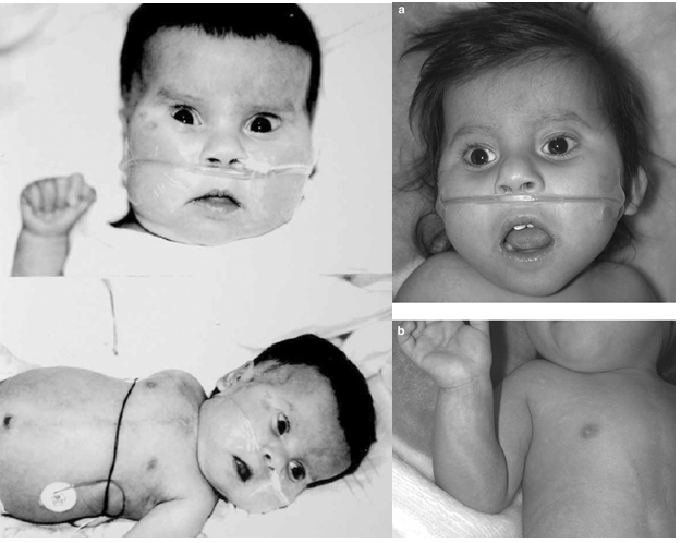 Figure 1: Images of children with mosaic trisomy syndrome of chromosome 14 [1].