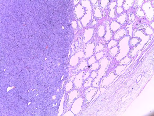 Figure 2: Low power view of tumor in continuity with testicular tissue.