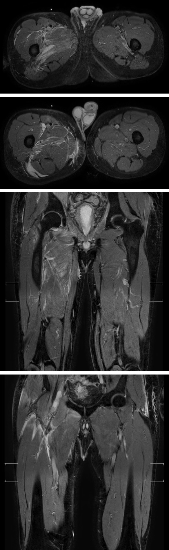 Figure 1: Magnetic resonance imaging of the abdomen, pelvis and lower limbs in transversal and coronal section. Hyperintense images corresponding to an inflammatory process are evidenced in the fibers of the iliopsoas muscle (distal segment), gluteus minimus and medius, quadratus femoris, internal and external obturator, adductors, pectineus and vastus lateralis consistent with pyomyositis of infectious etiology.
