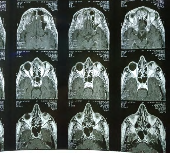 Figure 1: MRI showing melanoma of the left eye.