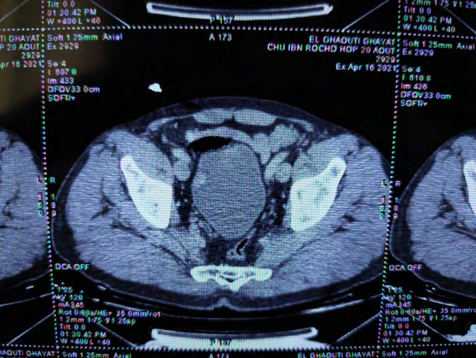 Figure 2: A computed tomography scan showing a 14mm × 9 cm, irregular, polypoidal mass in the urinary bladder.
