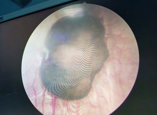Figure 3: Tumor measuring 2 cm, pedicled, blackish at the level of the bladder bottom.