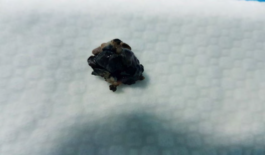 Figure 4: The tumor after resection.