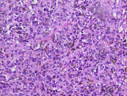 Figure 5: Bladder melanoma Gx40.