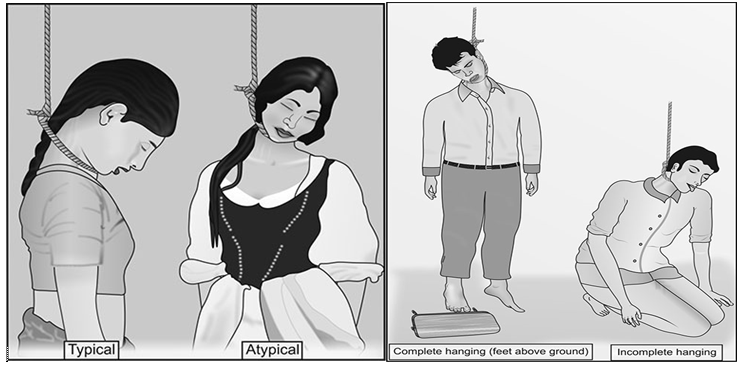 Figure 2: Typical and Atypical Hanging& complete and incomplete hanging.