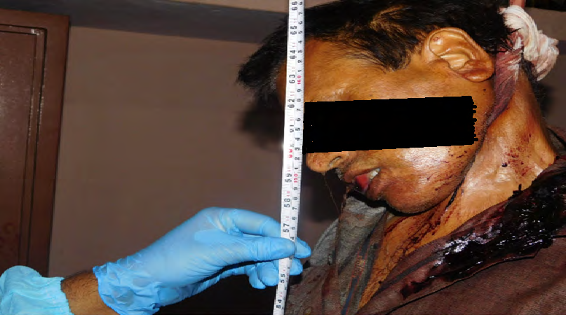 Figure 9: Salivary dribbling and protruded tongue and cloth smeared with blood.