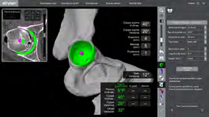Figure 3: Axial and 3D view of cup planning: by default 40° tilt and 20° anteversion.