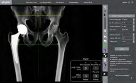 Figure 4: Preoperative planning with 0-length result with contralateral hip and global offset reduced by 3 mm.