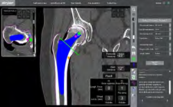 Figure 5: Stem version planning: natural femoral neck version of -23° with prosthetic stem version planned at +12°.
