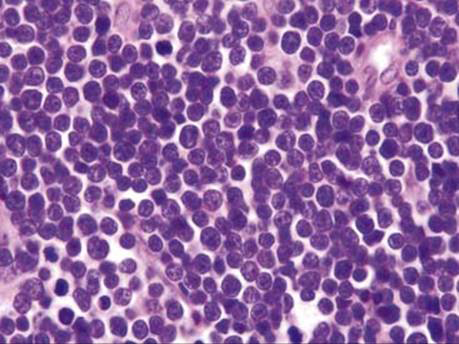 Figure 1: T lymphoblastic lymphoma depicting disseminated neoplastic lymphocytes with imbued with scant, basophilic cytoplasm, enlarged nuclei with delicate chromatin, convoluted nuclear membrane, nuclear grooves and indistinct nucleoli [2-5].
