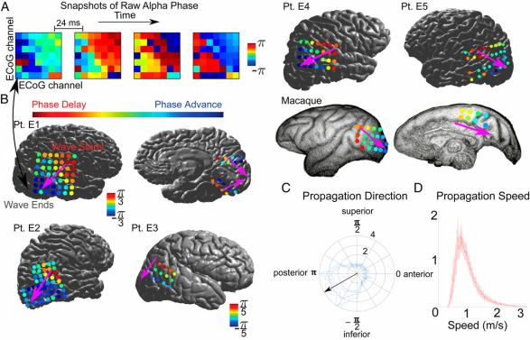 Figure 2: Figure illustrates Alpha propagates from anterosuperior to posteroinferior cortex. (A) Alpha-phase snapshots from Pt. L1 demonstrate propagation from the grid’s top-right (anterosuperior) to bottom-left corner (posteroinferior). (B) Average circular distance of each contact’s alpha phase from the spatial mean phase during eye closure. In all patients, alpha propagates toward posteroinferior areas. Overlaid arrow is the direction of the grid’s average phase gradient. Color runs from ±π3 in Pts. E1, E2, and E5 and macaque; and from ±π5 in Pts. E3 and E4. (C) Average probability distribution of traveling wave directions across time such that the bottom left contact is the most posteroinferior (±SEM across patients). (D) Average probability distribution of traveling wave speeds (±SEM across patients) [11].