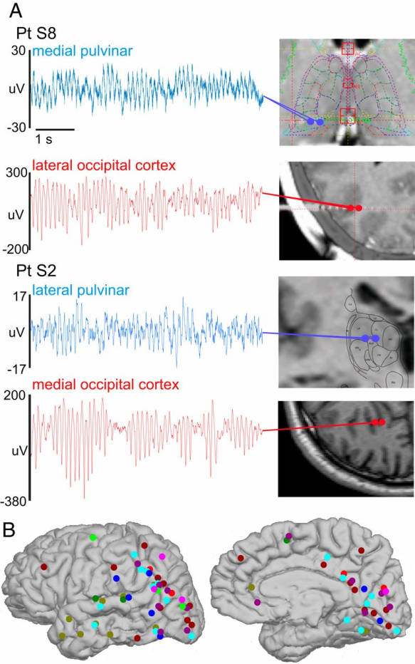 Figure 3: Figure illustrates Robust alpha rhythms can be recorded in human pulvinar and cortex. (A) Representative 6-s LFPg traces of simultaneous thalamic and cortical alpha activity. Prominent, largely continuous alpha rhythms can be recorded in various locations within the pulvinar as well as posterior cortex. (B) Cortical implant locations in all SEEG patients displayed on Pt. S3′s brain. Each color signifies a different patient [11].