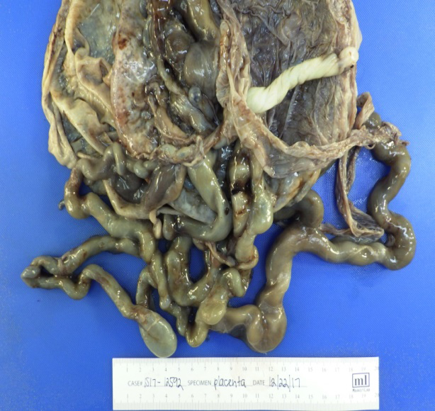 Figure 1: A placenta with a normal three-vessel umbilical cord and multiple markedly dilated tortuous vessels.