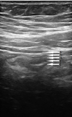 Figure 2: Bowel ultrasound anatomy - normal stratification: 1- interface of lumen content and mucosa (hyperechoic), 2 - mucosa (hypoechoic), 3 - submucosa (hyperechoic), 4 - muscular layer (hypoechoic), 5 - serosa (hyperechoic).