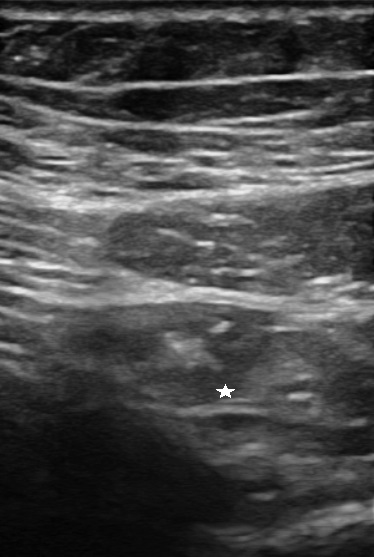 Figure 3: Ileal ultrasound: hypoechoic submucosa (star) along mesenterial edge.