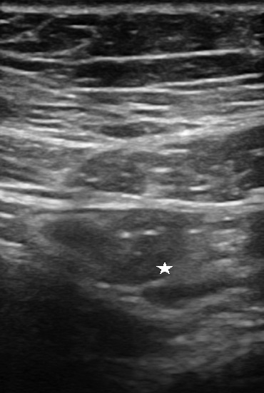 Figure 4: Ileal ultrasound: hypoechoic submucosa (star) along mesenterial edge.
