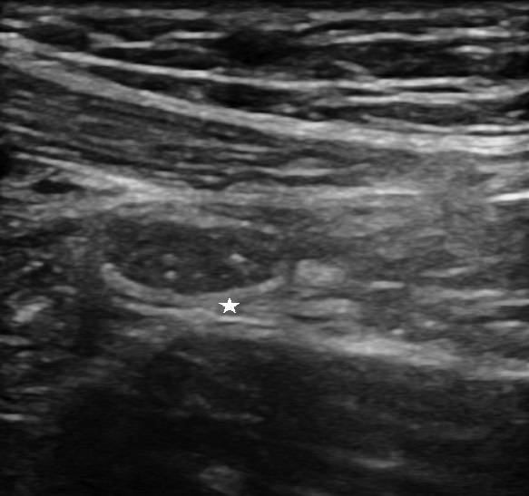 Figure 6: Ileal ultrasound: ileal loop with normal echogenicity of submucosa (star).