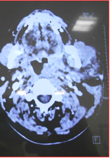 Figure 7: Closure of Tracheostomy wound.