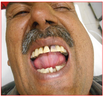 Figure 8: Post operative frontal profile.