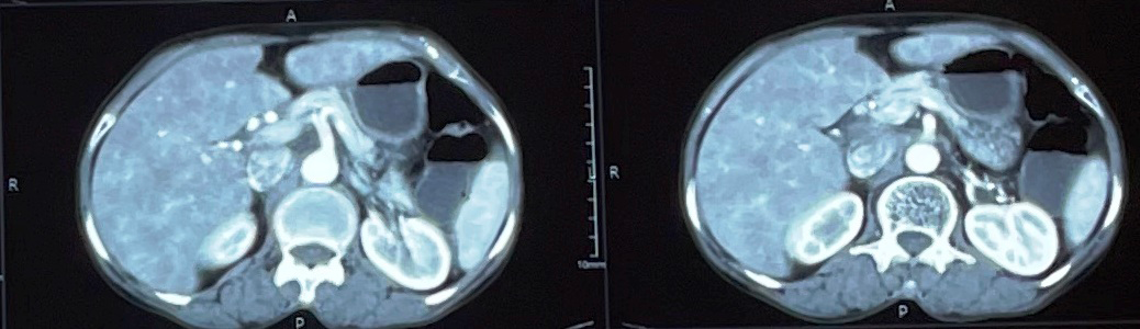 Figure 1: Computed tomography (CT) scan abdomen and pelvis showed an intra-abdominal well defined, thin walled cystic lesion.