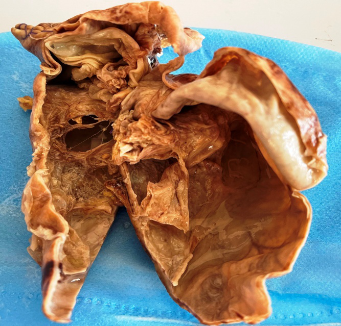 Figure 2: Mesentric Cyst measuring 12.5x 9.9 cm with smooth external surface and on cut open showed a large cyst with thin wall and multiloculations.