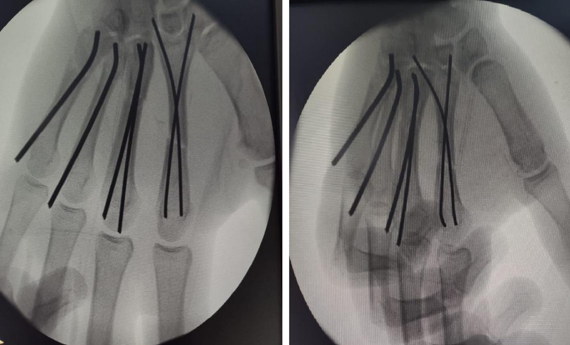 Figure 5: Control radiograph.
