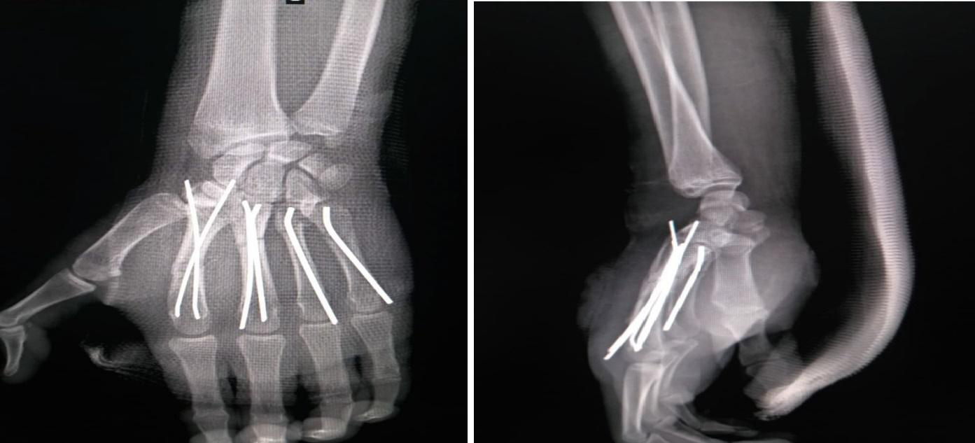 Figure 7: Clinical and radiological aspects of the second clinical case, and functional outcomes at the fifth month.