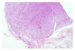 Figure 11: Delineated NIFTP with intact capsule H&E X100.