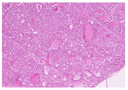 Figure 13: Mixed follicles with nuclear features and intact capsule H&E X100.