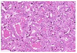 Figure 14: Nuclear features without psammoma or necrosis H&E X400.