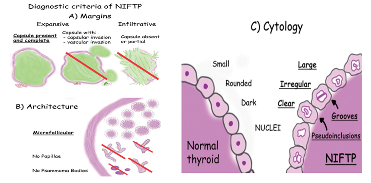 Figure 2: A) Margins of the nodule: a NIFTP has definite, expansive margins, usually encircled by a continuous, intact capsule (left). If capsular or vascular invasions are present (middle), or if the capsule is discontinuous or completely absent and the nodule has infiltrative margins towards the surrounding parenchyma (right), then the lesion cannot be diagnosed as NIFTP. B) Architecture of the nodule: a NIFTP as a prevalent microfollicular pattern of growth (up) and no papillae or psammoma bodies are allowed (down). C) Nuclear features: NIFTP have large, clear and irregular nuclei, with frequent grooves and occasional pseudoinclusions. NIFTP nuclei (right) differ significantly from regular nuclei of normal thyrocytes (left), which are small, rounded and dark [10].