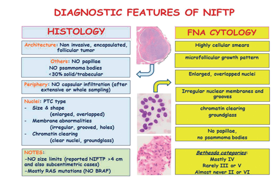 Figure 3: Summary of histological and cytological features of NIFTP. The figure summarizes the histological (left) and cytological (right) diagnostic features of NIFTP [10].